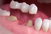 Artificial Teeth Services in Indore Dr Atul Jajoo